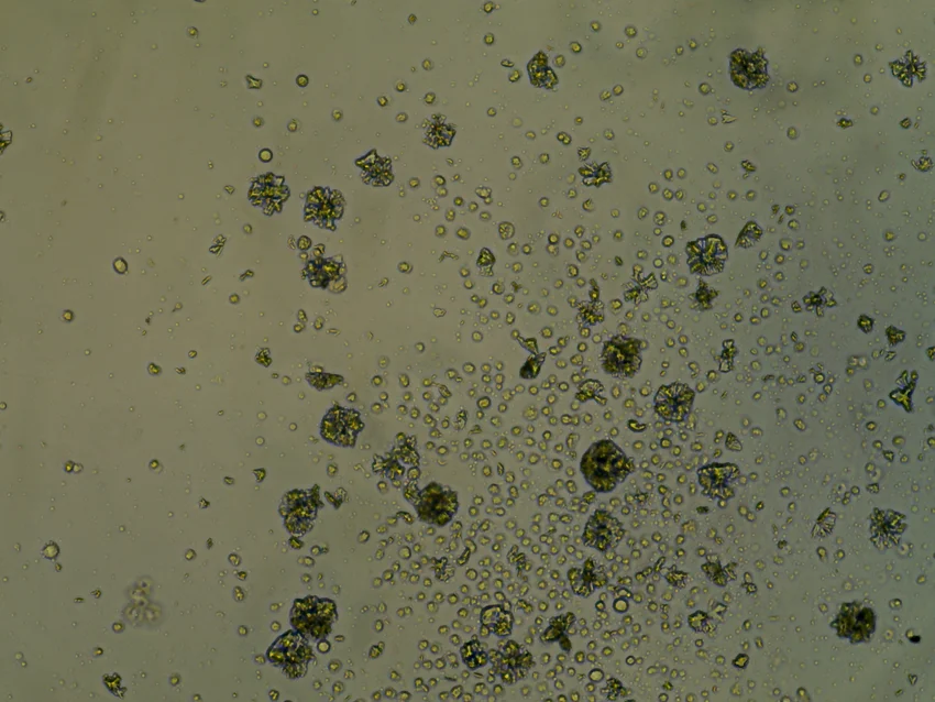 Cell-culture microscopy — cells and crystal clusters from the CAR-T detection assay