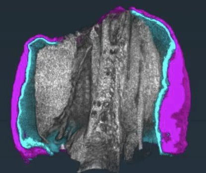 3D reconstruction of an axolotl limb stump, with epidermis in magenta and stratum compactum in cyan